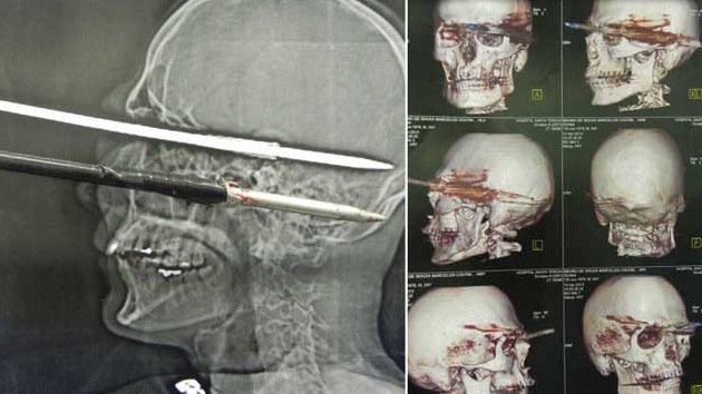 Un pescador brasileño se perfora el cráneo accidentalmente con un arpón y sobrevive