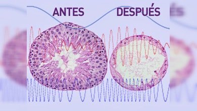 Ondas de ultrasonido: contraceptivo masculino