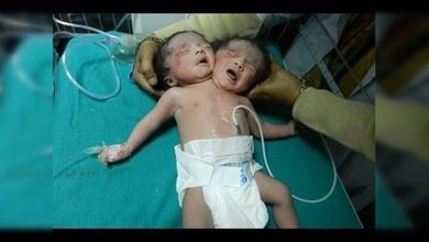 Nace en la India un bebé con dos cabezas