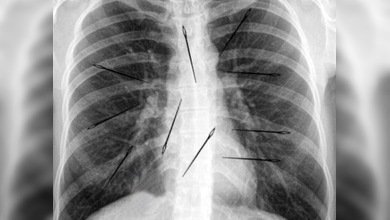Mujer vive 20 años con agujas en el cuerpo sin saberlo