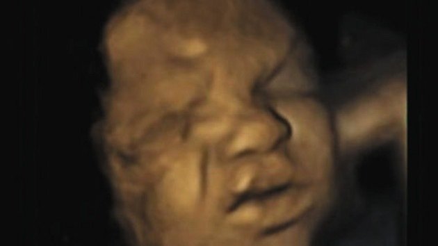 Fotos: Los bebés en el útero fruncen el ceño para prepararse para el dolor del parto