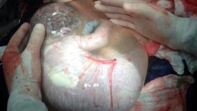 Sacan una foto a un bebé recién nacido aún dentro de su bolsa amniótica
