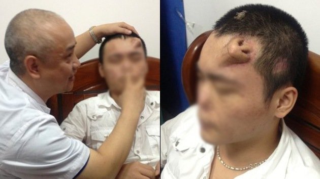 Video: Después de un accidente de tráfico, le implantan una nariz en la frente
