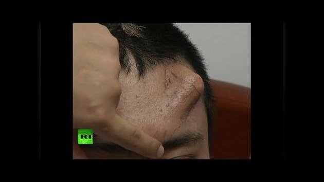 China: A un hombre le 'crece' una nariz en la frente