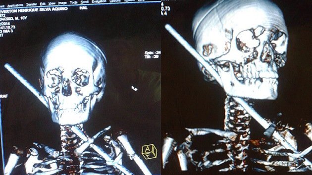 Un brasileño de 10 años sobrevive tras atravesarle el cuerpo una barra de acero