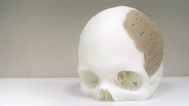 Reconstruyen el 75% del cráneo con implantes impresos en 3D