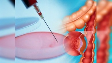 El análisis de heces, tan eficaz como la colonoscopia para detectar cáncer de colon