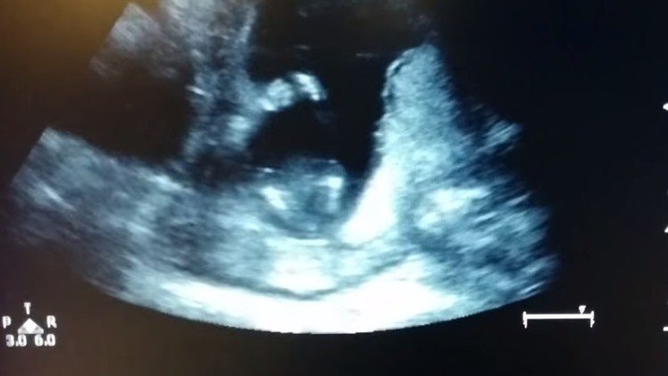 Un feto de 14 semanas aplaude durante una ecografía
