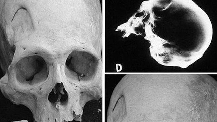 Escalofriante: Encuentran en Bolivia esqueletos que muestran las primeras cirugías cerebrales