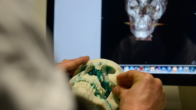 Por primera vez en la historia transplantan a una niña de tres años un cráneo hecho en impresora 3D