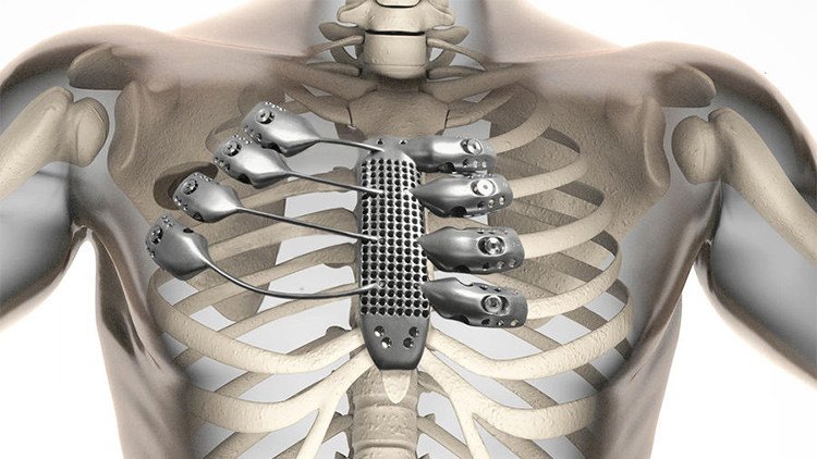 Implante pionero de costillas metálicas impresas en 3D
