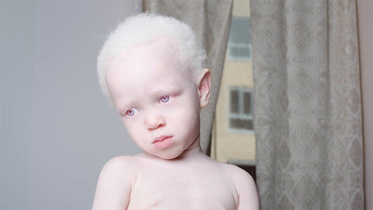 Impactantes imágenes de personas albinas centran nuestra mirada en sus bellos rasgos únicos
