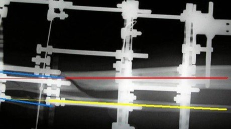 Alargar huesos: un negocio médico floreciente en India