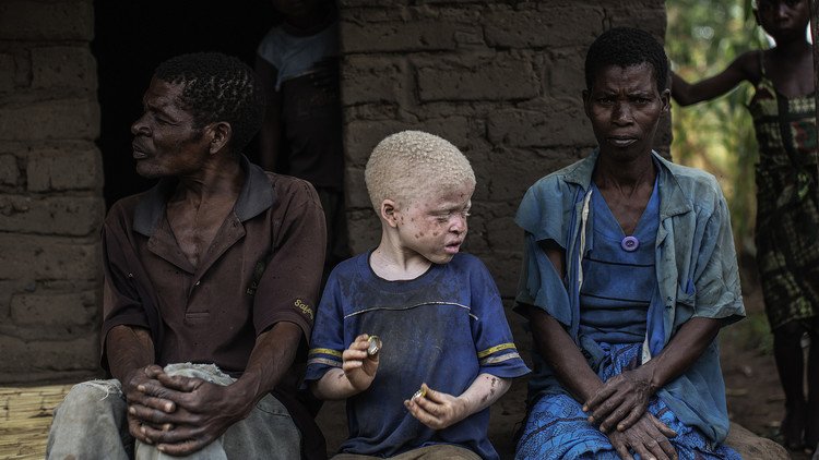 La caza de los niños albinos en África, víctimas de la magia y la superstición