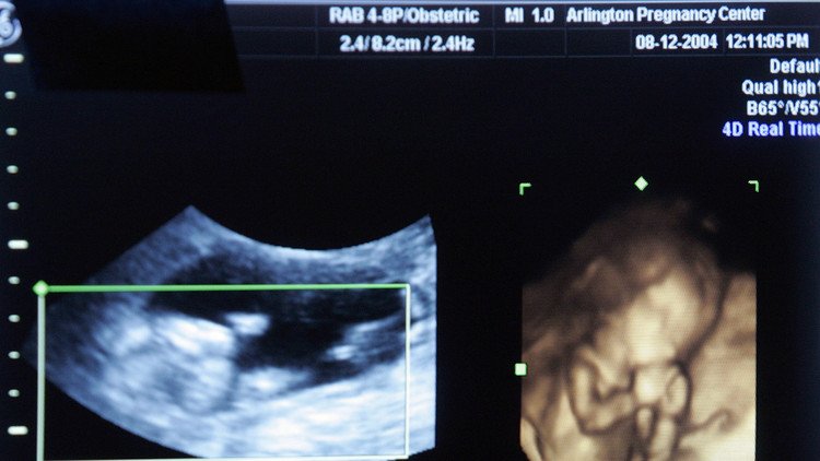 Una embarazada ve en una ecografía la cara de 'Scream'