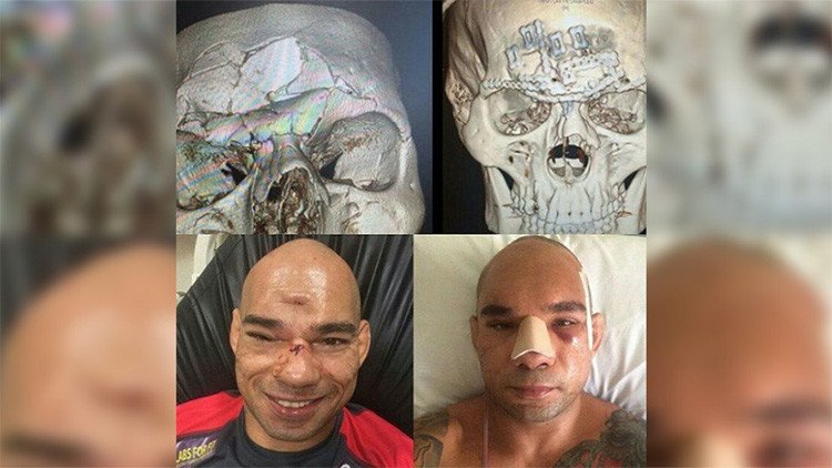 Fotos: Así quedó el 'Cyborg' brasileño después de que su rival le fracturara el cráneo