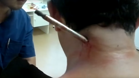 Espeluznante escena: Arpón disparado por error por su amigo le atraviesa el cuerpo