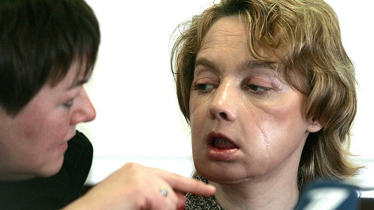 Fallece en Francia la primera persona que fue sometida a un trasplante de cara en el mundo