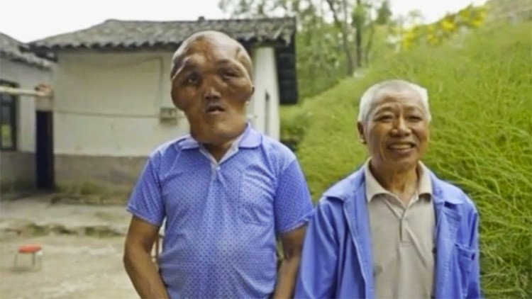 'Cabeza de alienígena': Una extraña enfermedad deforma el rostro de un hombre en China