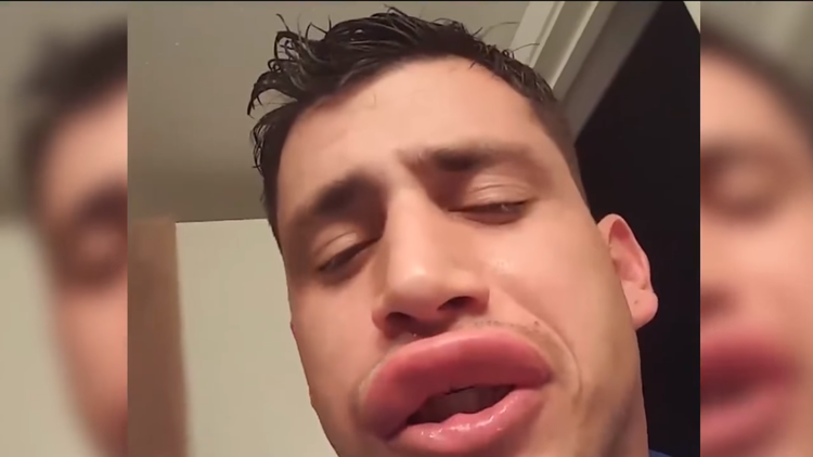 Le pica una avispa en la boca y dedica un video a quienes se aumentan los labios
