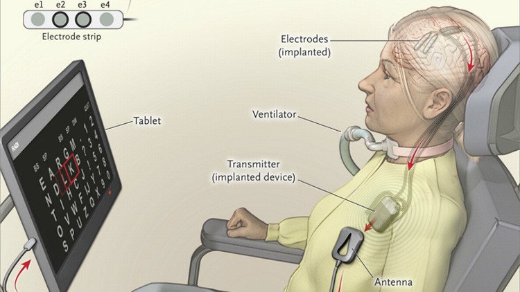 Hablando con la mente: Un implante en el cerebro permite comunicarse a una mujer con parálisis