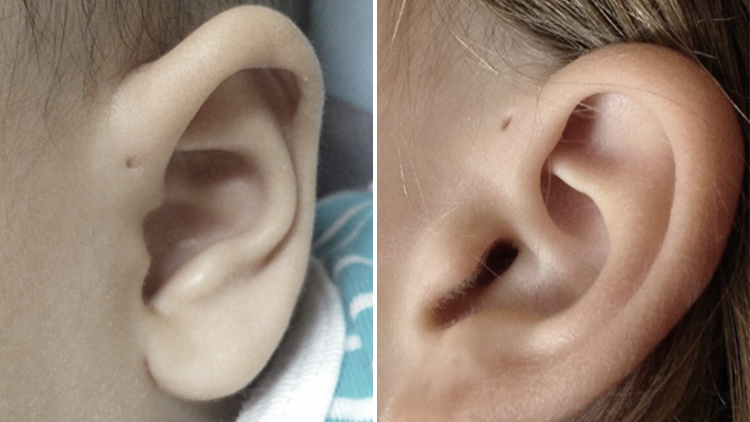 ¿Por qué algunas personas tienen estos agujeros en las orejas?
