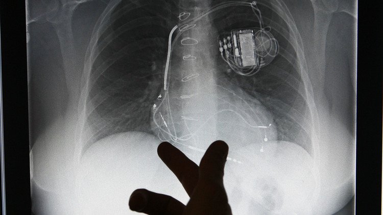 El corazón puede ser 'hackeado': encuentran 8.000 fallos de seguridad en marcapasos