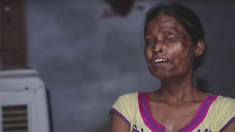 "Amenaza con matarnos": por qué una madre y una hija desfiguradas con ácido viven con su atacante