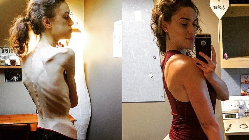 Instagram le salvó la vida: Las duras imágenes del antes y después de una sobreviviente de anorexia