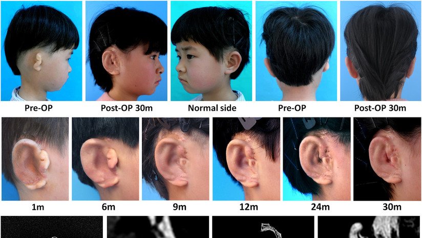 Científicos logran hacer crecer orejas en cinco niños a partir de sus propias células (FOTOS)