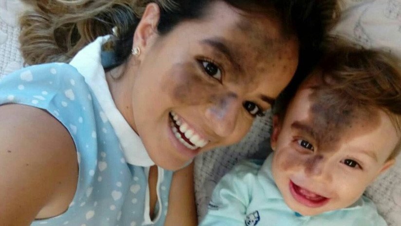 Se maquilla en la cara la mancha de su hijo para celebrar la singularidad del bebé