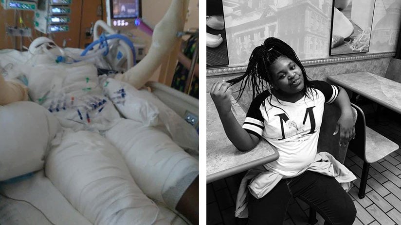 "Ardió desde las rodillas hasta el pelo": Niña de 12 años sufre graves quemaduras en un reto viral