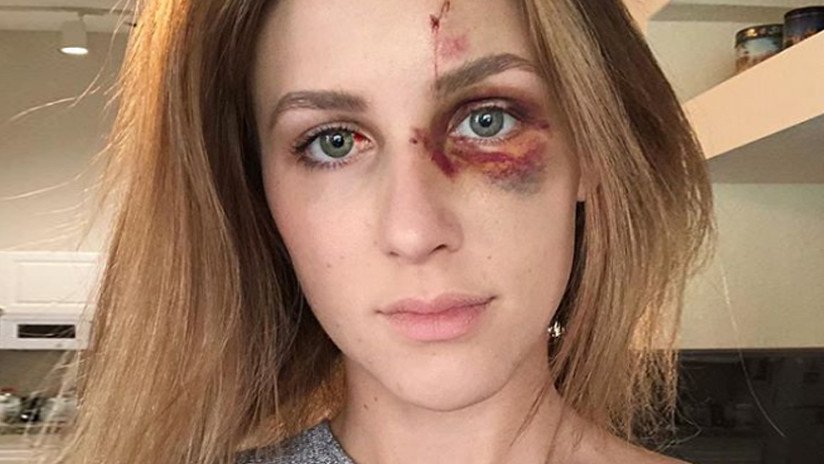 FOTOS: Así quedó el rostro de una joven brasileña golpeada por su novio millonario