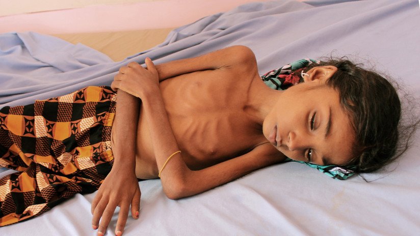Niños hambrientos afrontan "riesgo inminente de muerte" tras los ataques saudíes a Hodeida