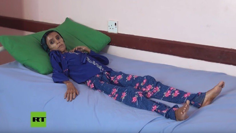 Una niña que pesa 10 kilogramos refleja el drama de la guerra en Yemen