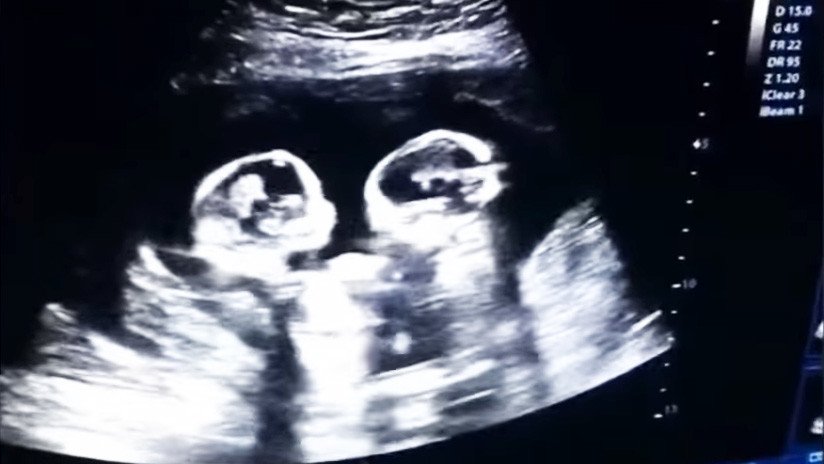 VIDEO: Una ecografía capta la 'pelea' entre dos gemelas en el vientre de su madre
