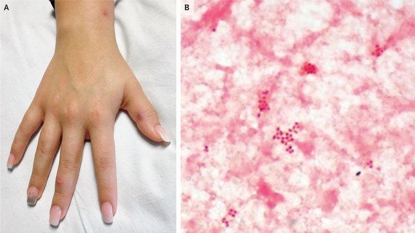 Una joven acude al médico en EE.UU. con erupciones en la piel y le diagnostican gonorrea