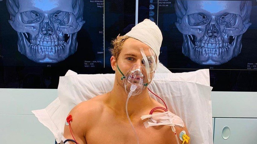 VIDEO, FOTO: Un brutal nocaut envía a un luchador de MMA directo al quirófano con ocho fracturas en el rostro