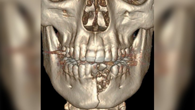 FOTO: Un joven de EE.UU. termina con la mandíbula fracturada al estallarle un cigarrillo electrónico en la boca