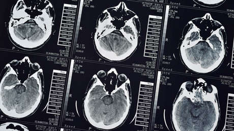 Descubre que una enorme tenia se alojó en su cerebro por un año y esa resultó ser la mejor noticia que podía esperar