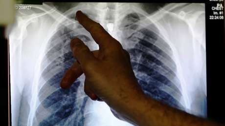 A una jubilada le colapsa un pulmón tras una acupuntura fallida