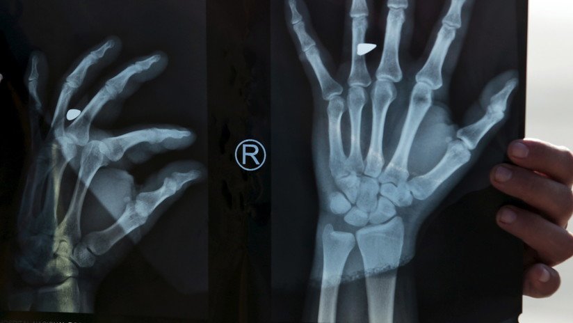 Se fractura el pulgar y se lo reemplazan con un dedo del pie por un error grave en la cirugía
