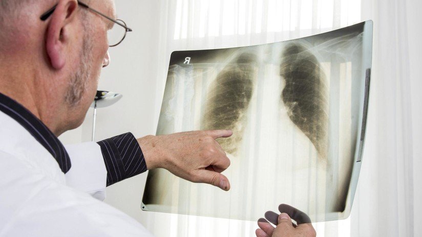 FOTOS: Quería donar sus pulmones, pero los doctores descubren que estaban negros tras fumar durante 30 años