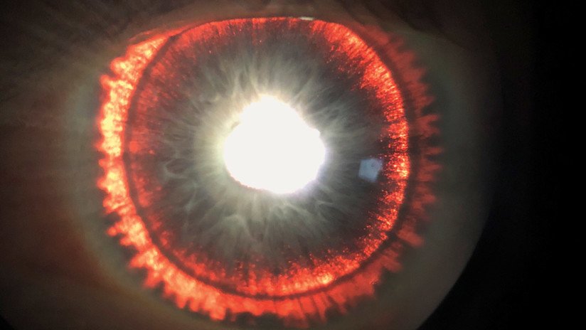 Una rara condición genética hace que las pupilas de un hombre se parezcan al ojo de Sauron