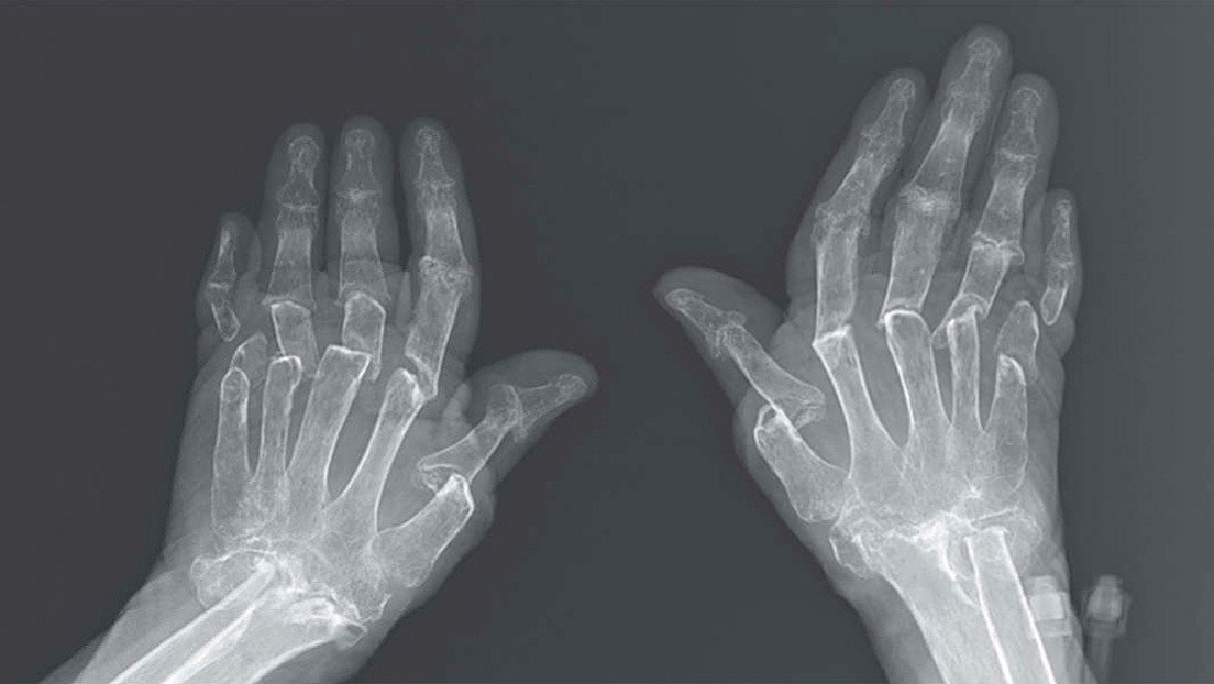 Dedos telescopados: Una enfermedad virtualmente incurable provoca una rara anomalía en las manos de una mujer (VIDEO)