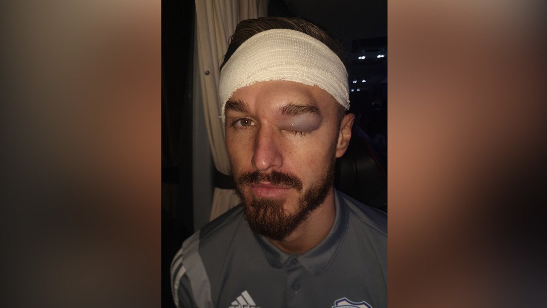 Futbolista muestra el enorme hematoma en su rostro que le causó el choque con la cabeza "hecha de concreto" de un compañero