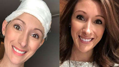 Exreina de belleza se desmaya en casa de unos amigos y acaba perdiendo parte del cráneo
