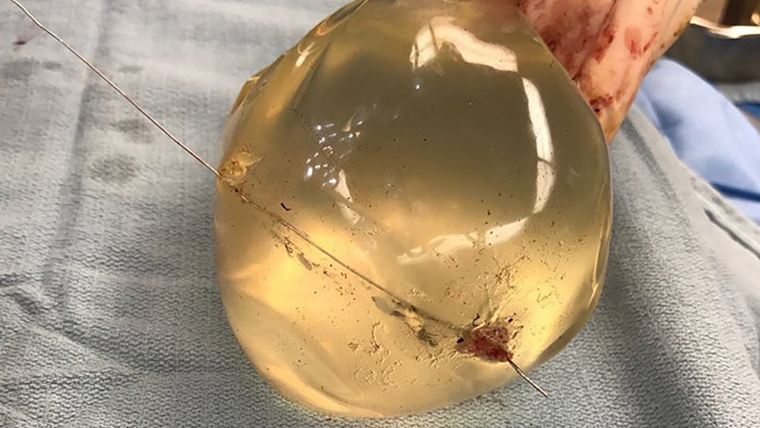 FOTOS: Implantes mamarios de una mujer le salvaron la vida, al detener una bala que iba a su corazón