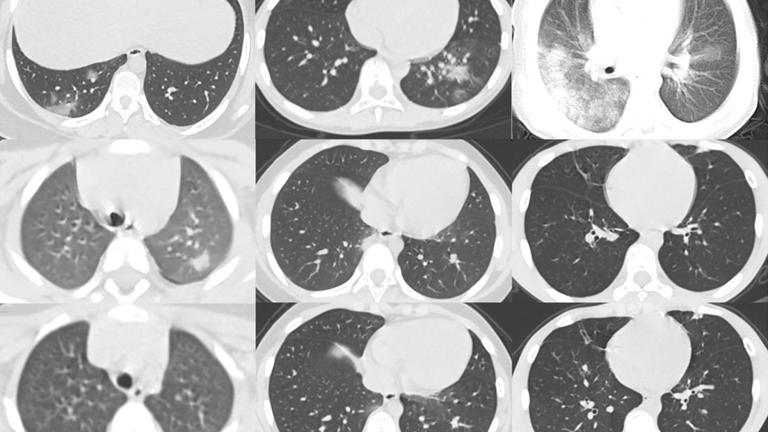 Un estudio de tomografías computarizadas revela cómo el coronavirus puede afectar los pulmones de un niño