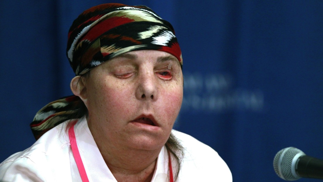 Una mujer recibe un segundo trasplante de cara en un cirujía pionera en EE.UU.